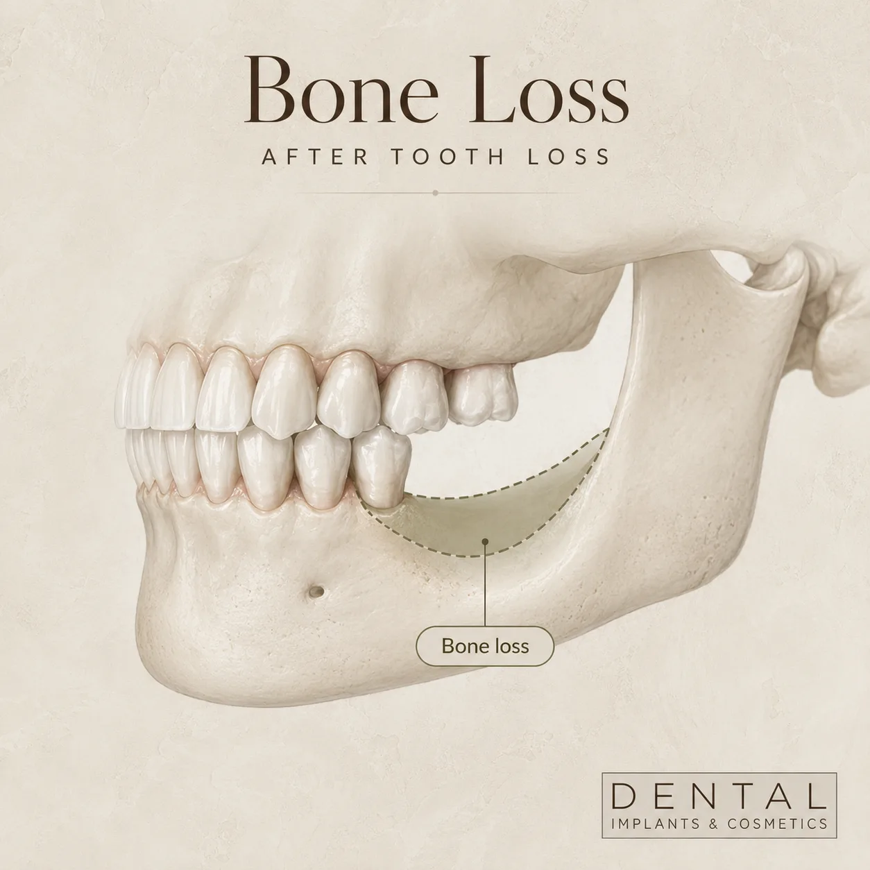 Diagram of jaw bone loss where implants would be ideal solution