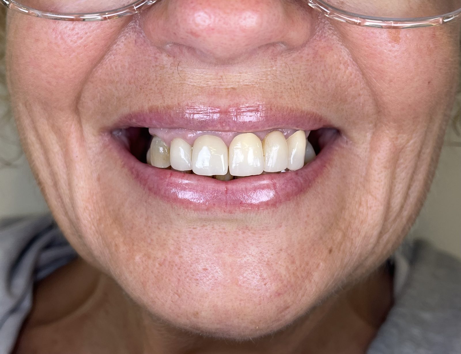 Before All on X dental implants in Plantation FL, patient with missing and damaged teeth