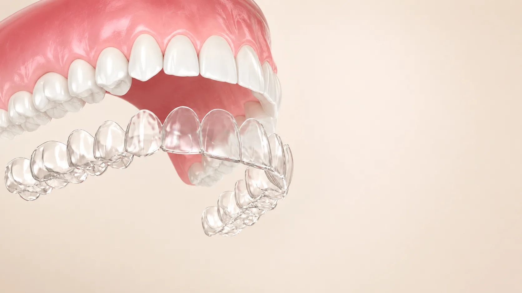 3D diagram of dental aligners being fitted over upper and lower teeth