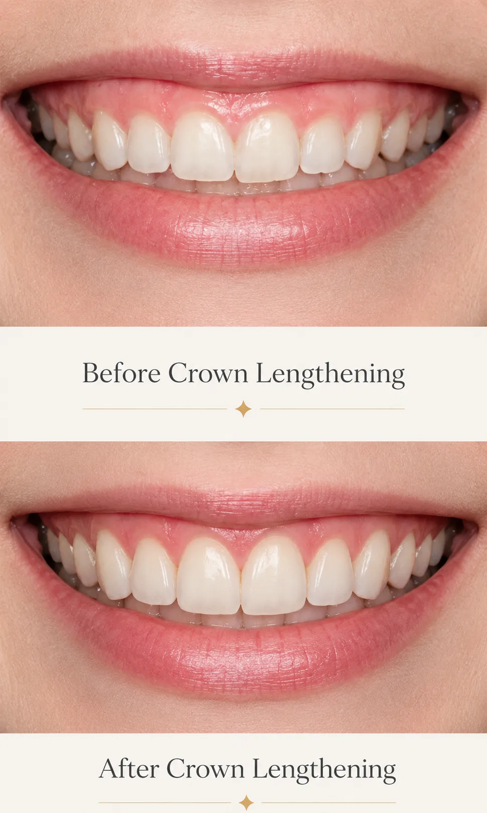 Crown lengthening before and after patient results Plantation Florida