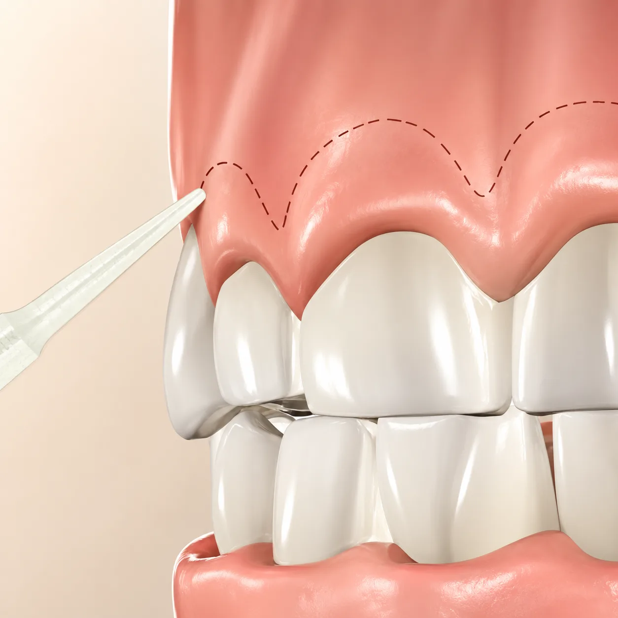 Crown lengthening surgical procedure 3D clinical render Plantation Florida