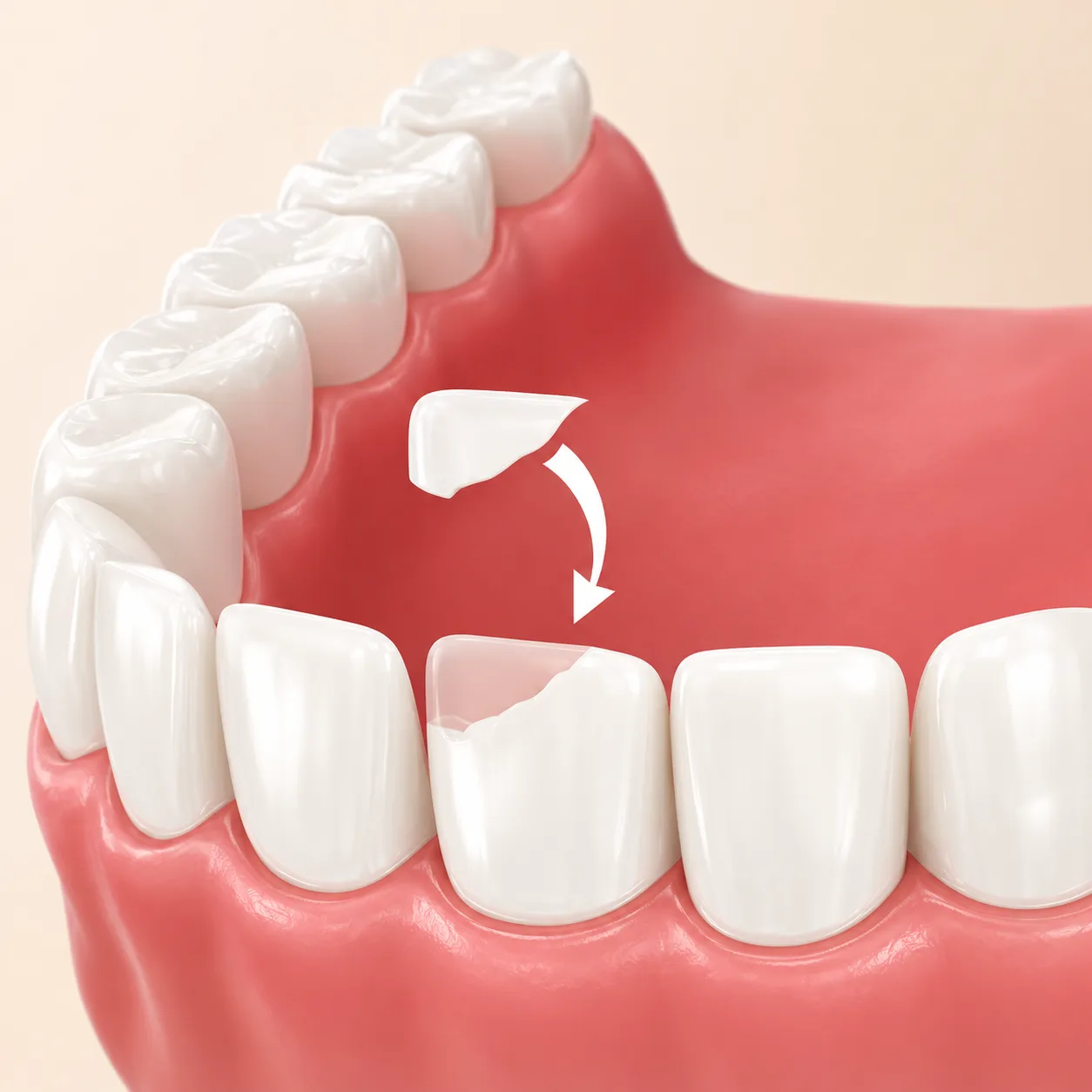 Chipped tooth fragment 3D clinical render Plantation Florida