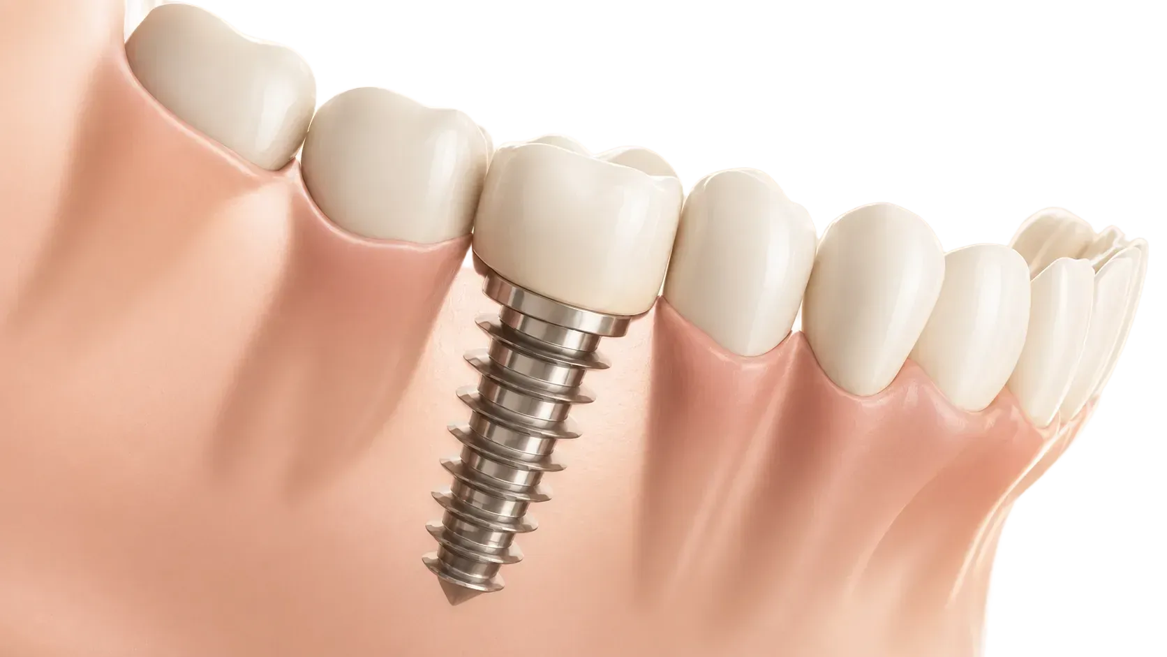 3D illustration of a dental implant titanium post placed in the jaw alongside natural teeth