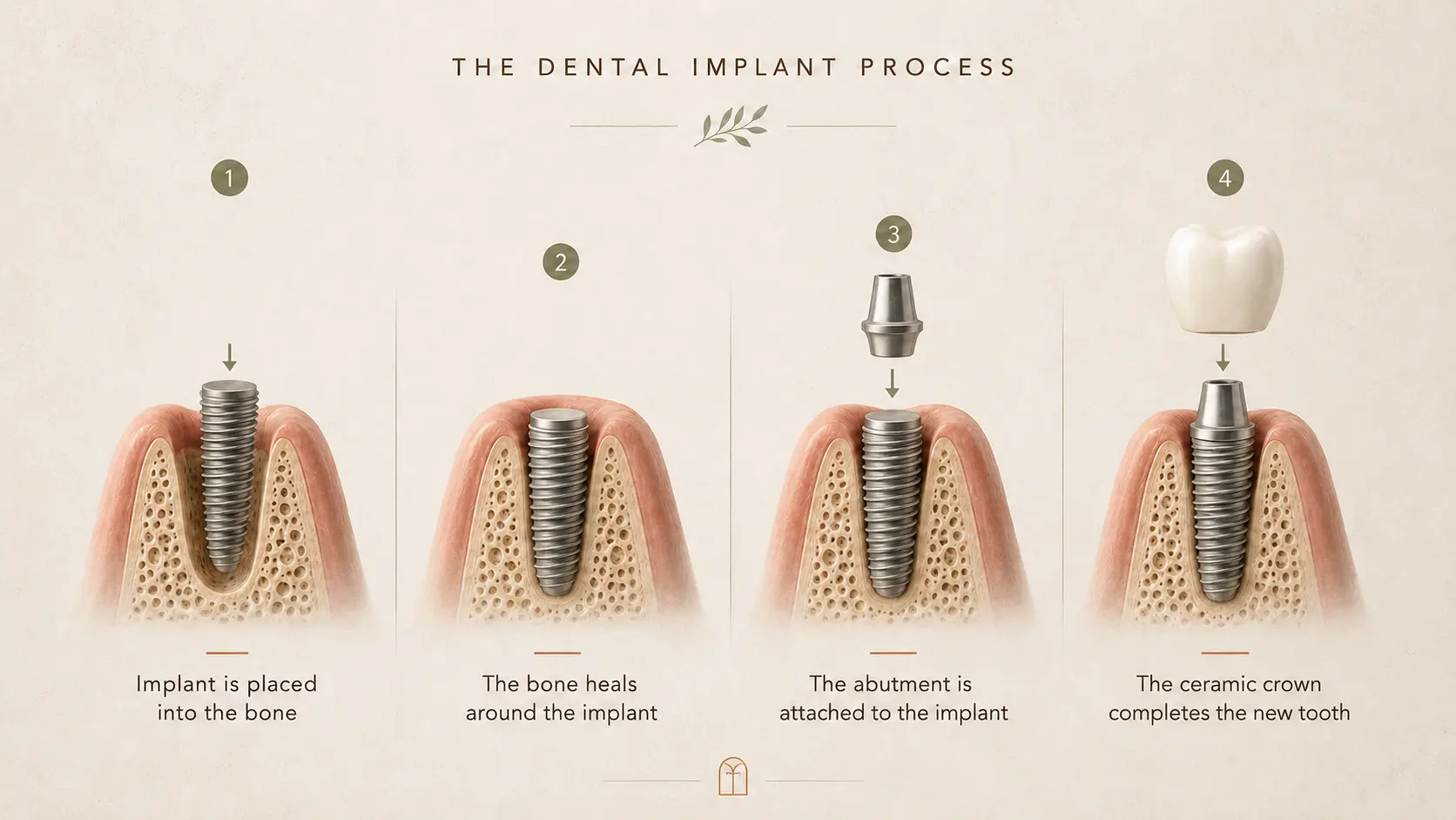 The dental implant process in four steps: implant placed into bone, bone heals around implant, abutment attached, ceramic crown completes the tooth