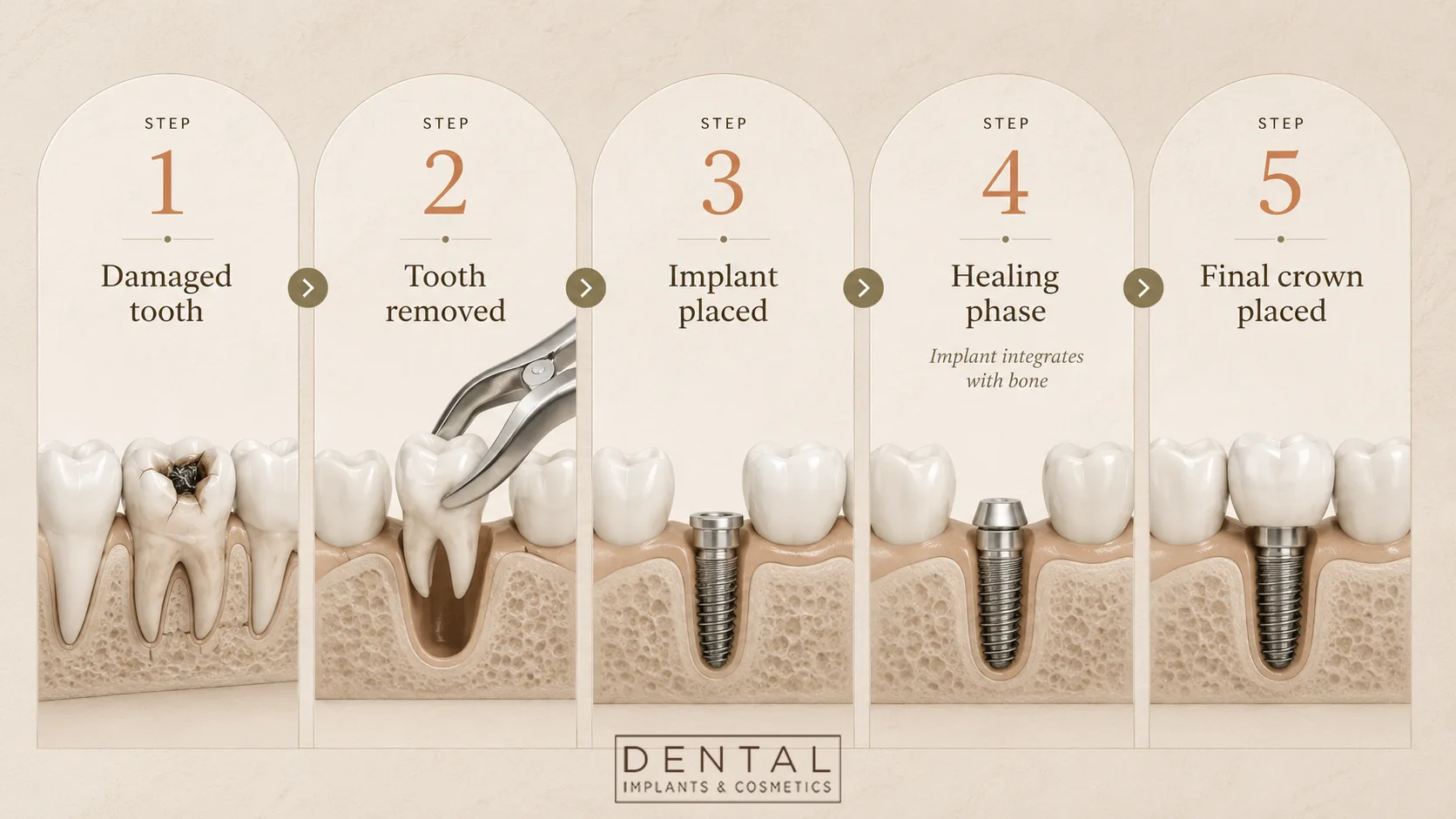 The five steps of dental implant treatment: damaged tooth, removal, implant placement, healing, and final crown