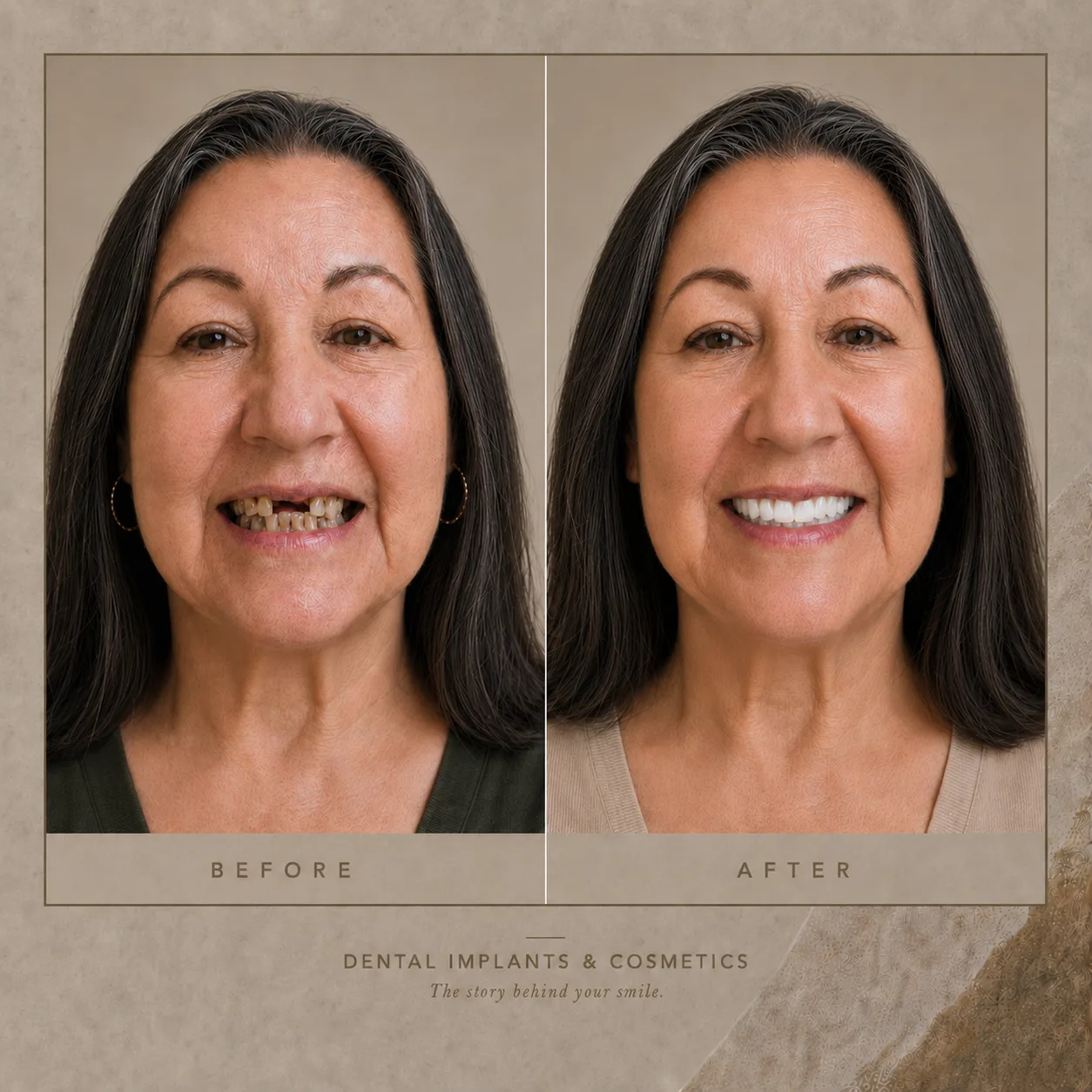 Dental implants before and after results at Dental Implants and Cosmetics Plantation