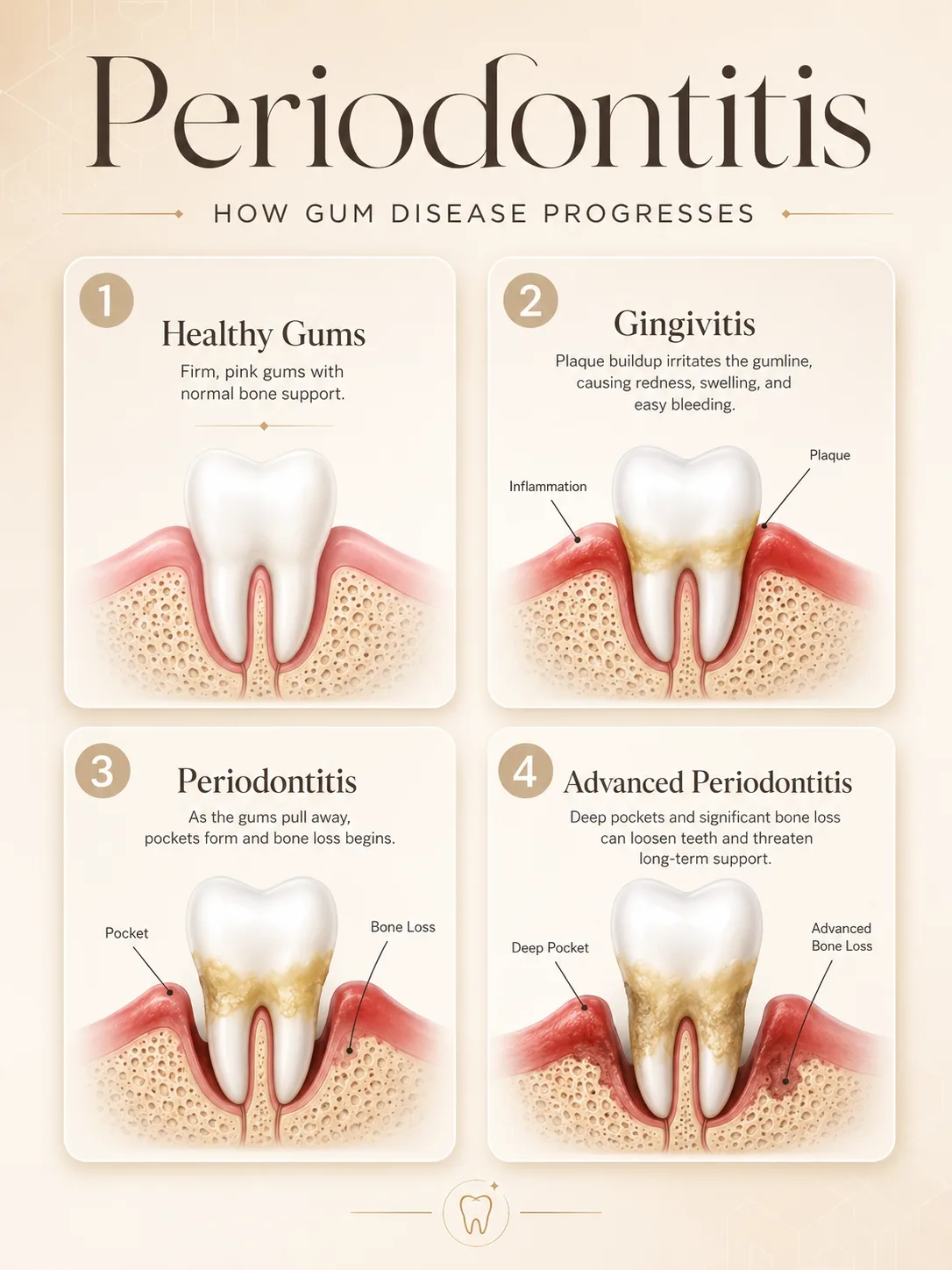 Periodontitis progression infographic showing four stages from healthy gums to advanced bone loss