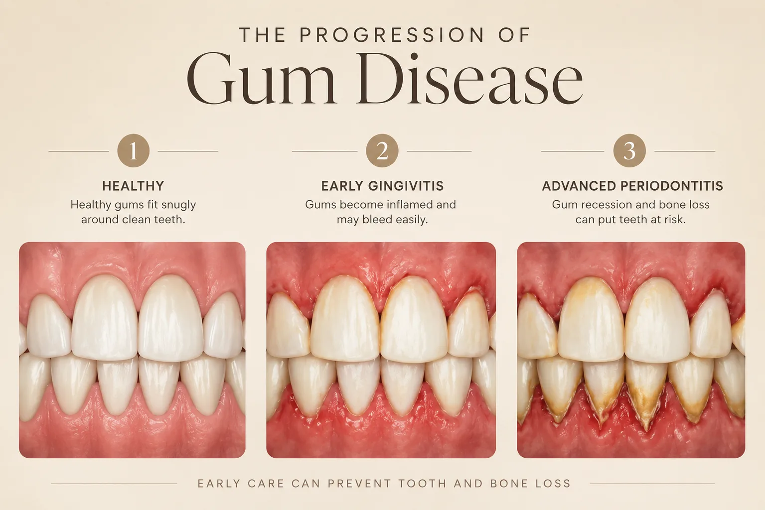 Three-stage comparison of healthy gums, early gingivitis, and advanced periodontitis