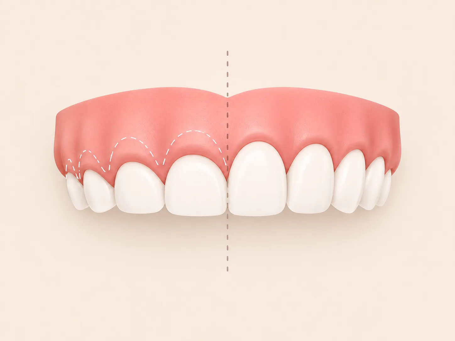 Gummy smile before and after clinical render Plantation Florida