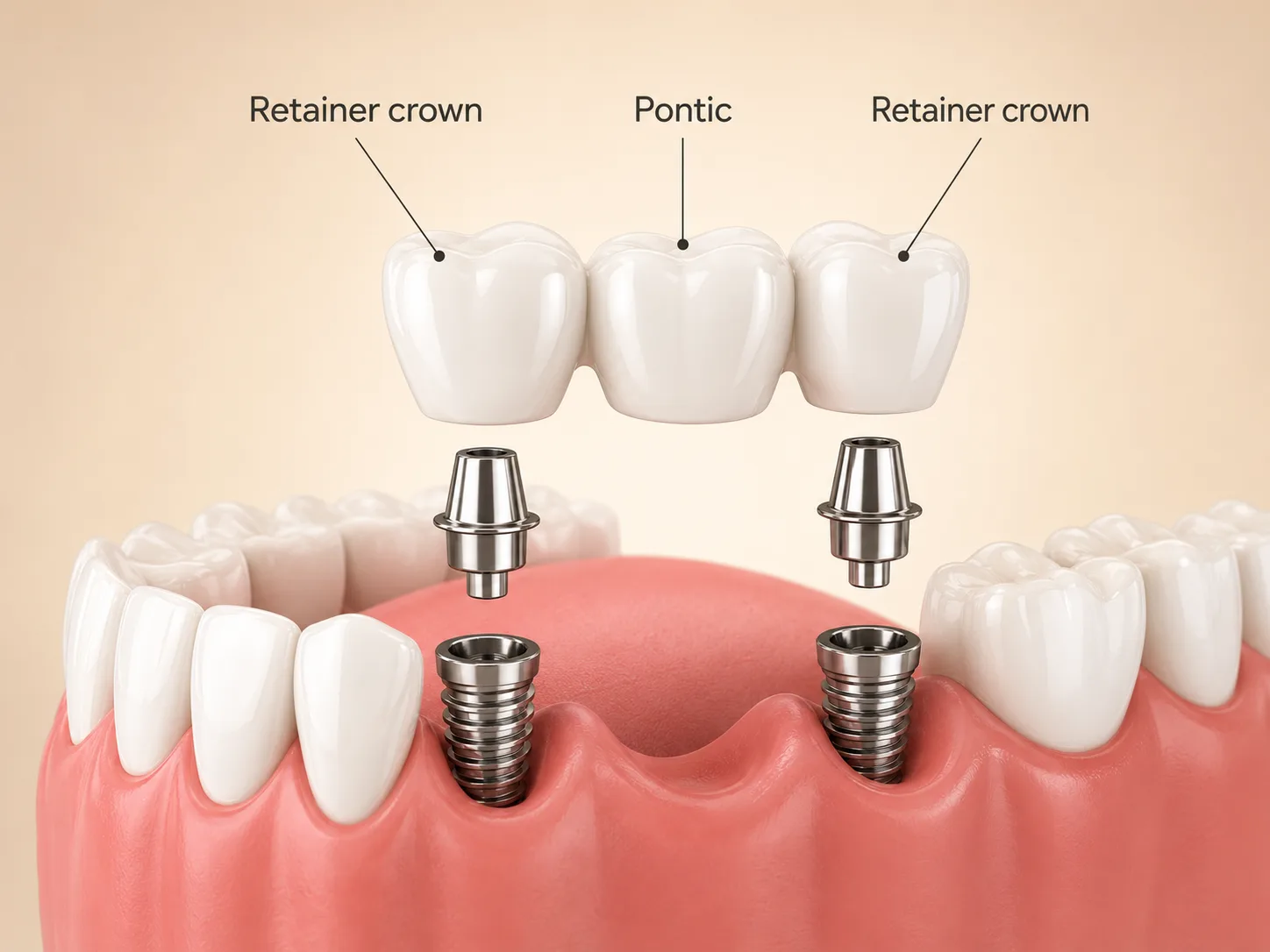 Diagram showing an implant bridge with two titanium posts, abutments, retainer crowns, and a pontic spanning the gap