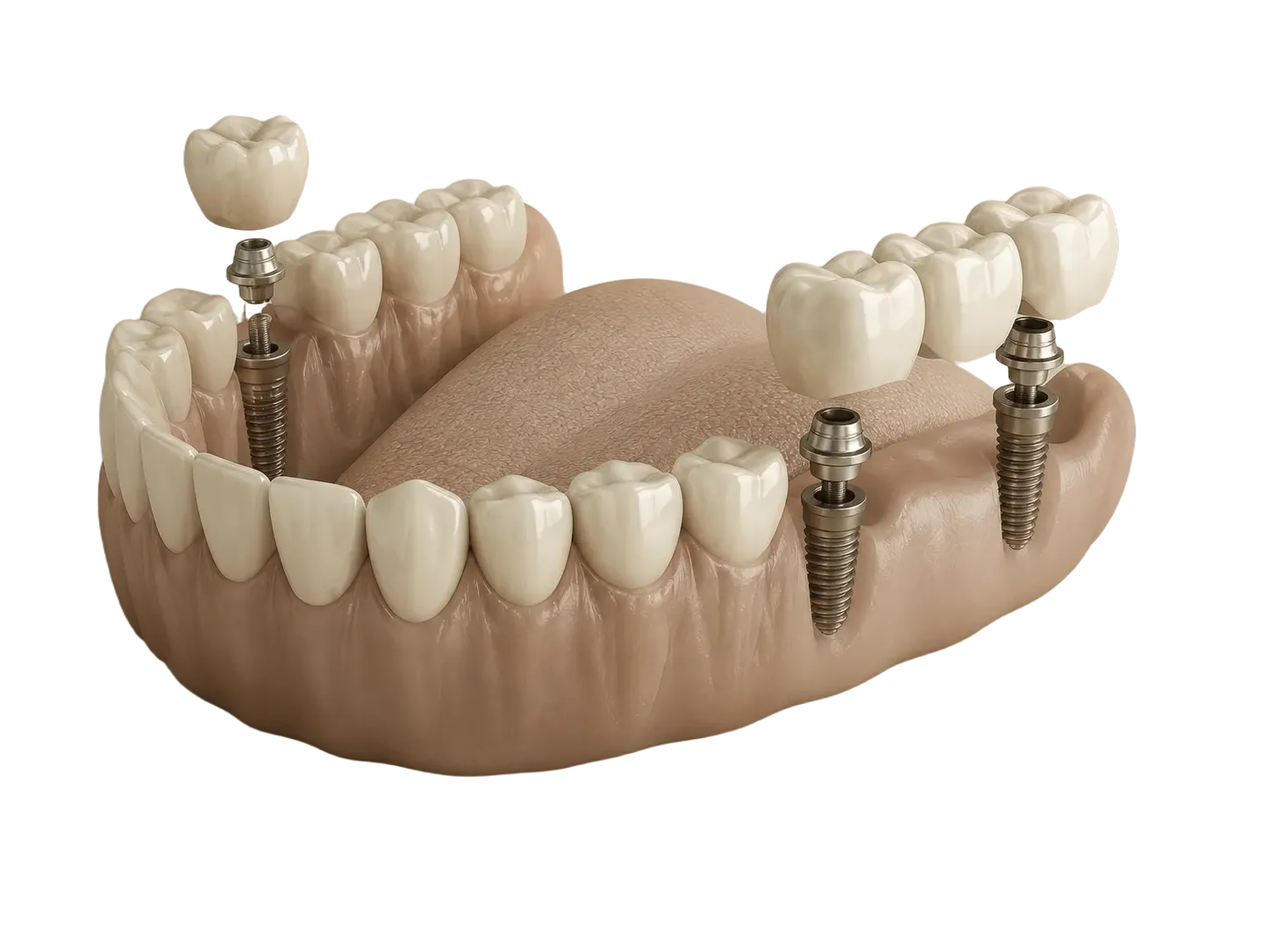 3D illustration of an implant bridge showing titanium posts and crown restorations in the jaw