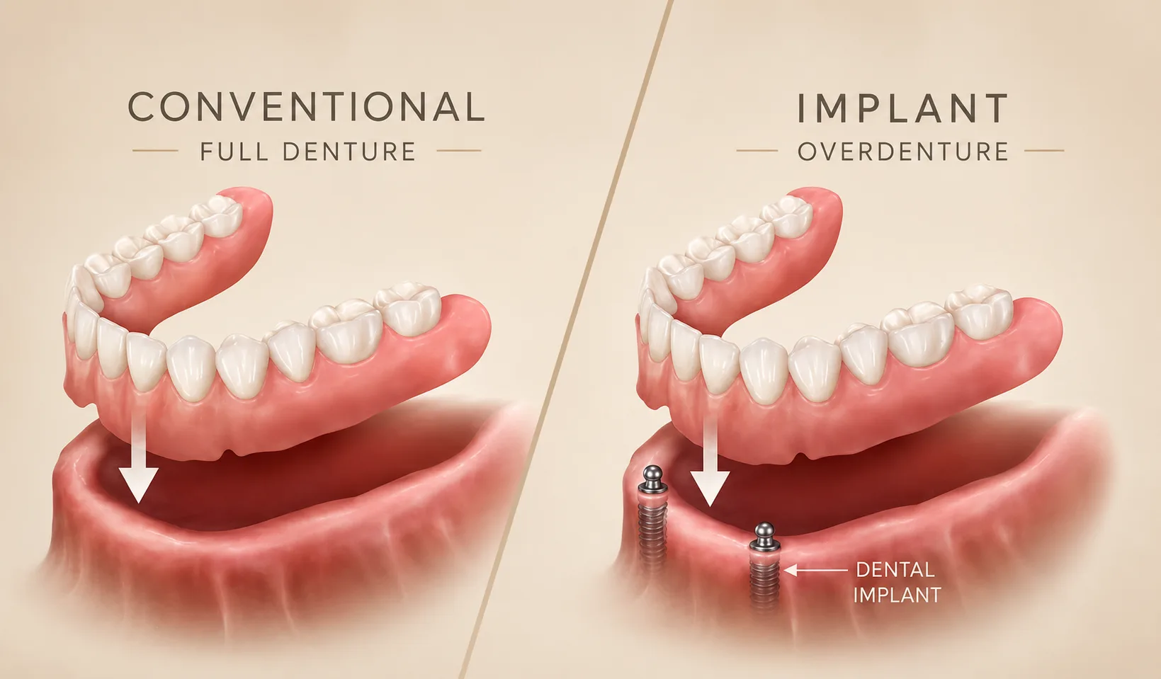 Diagram comparing a conventional full denture versus an implant supported overdenture