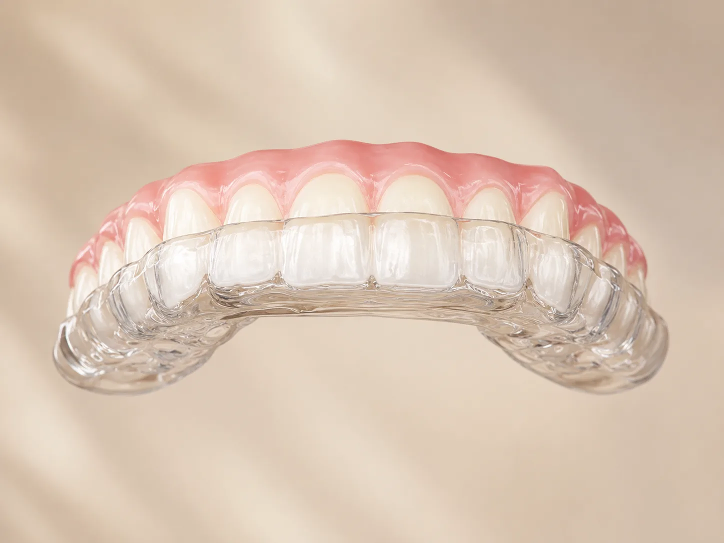Clear custom night guard fitted over upper teeth showing precise dental alignment