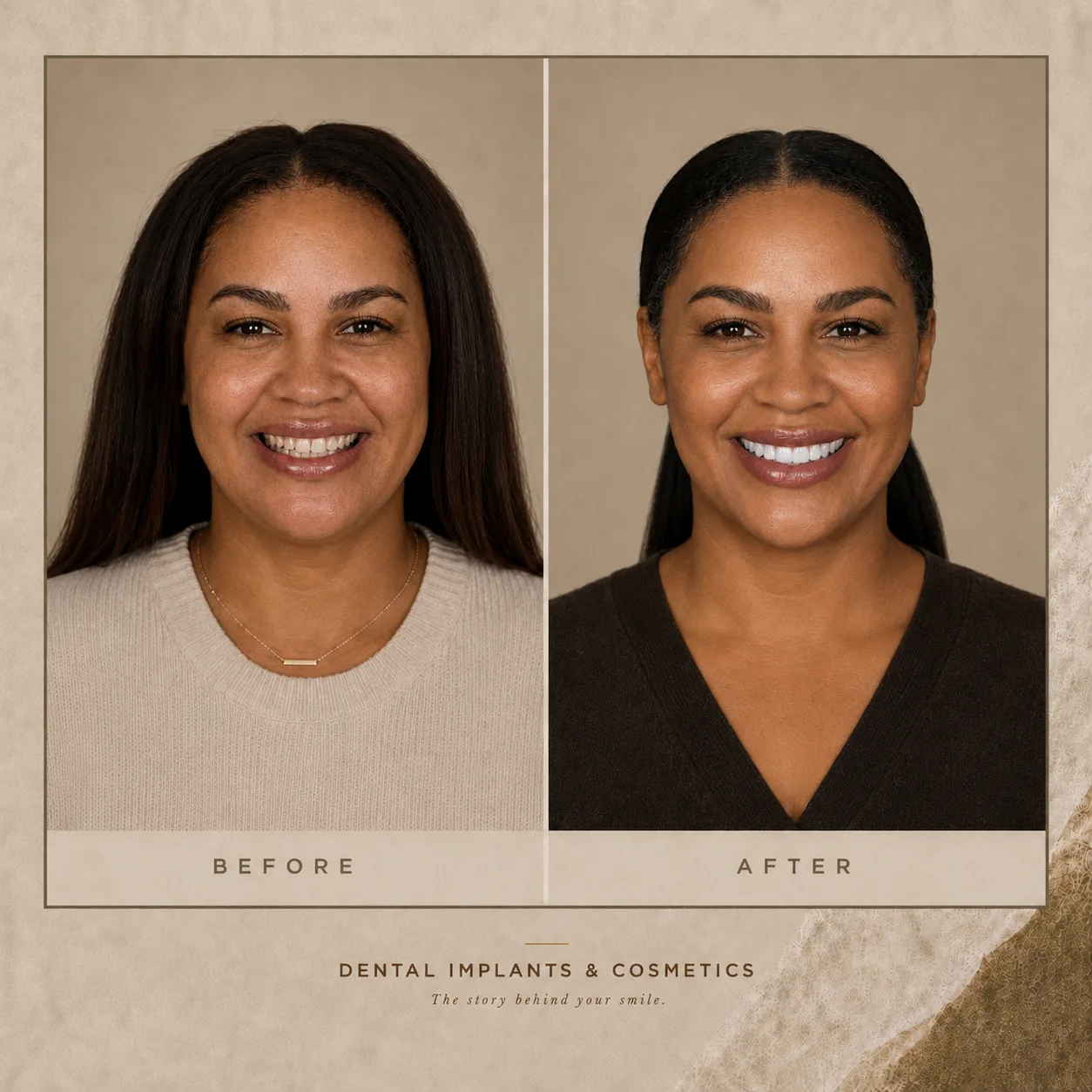 No prep veneers candidacy at Dental Implants and Cosmetics Plantation FL
