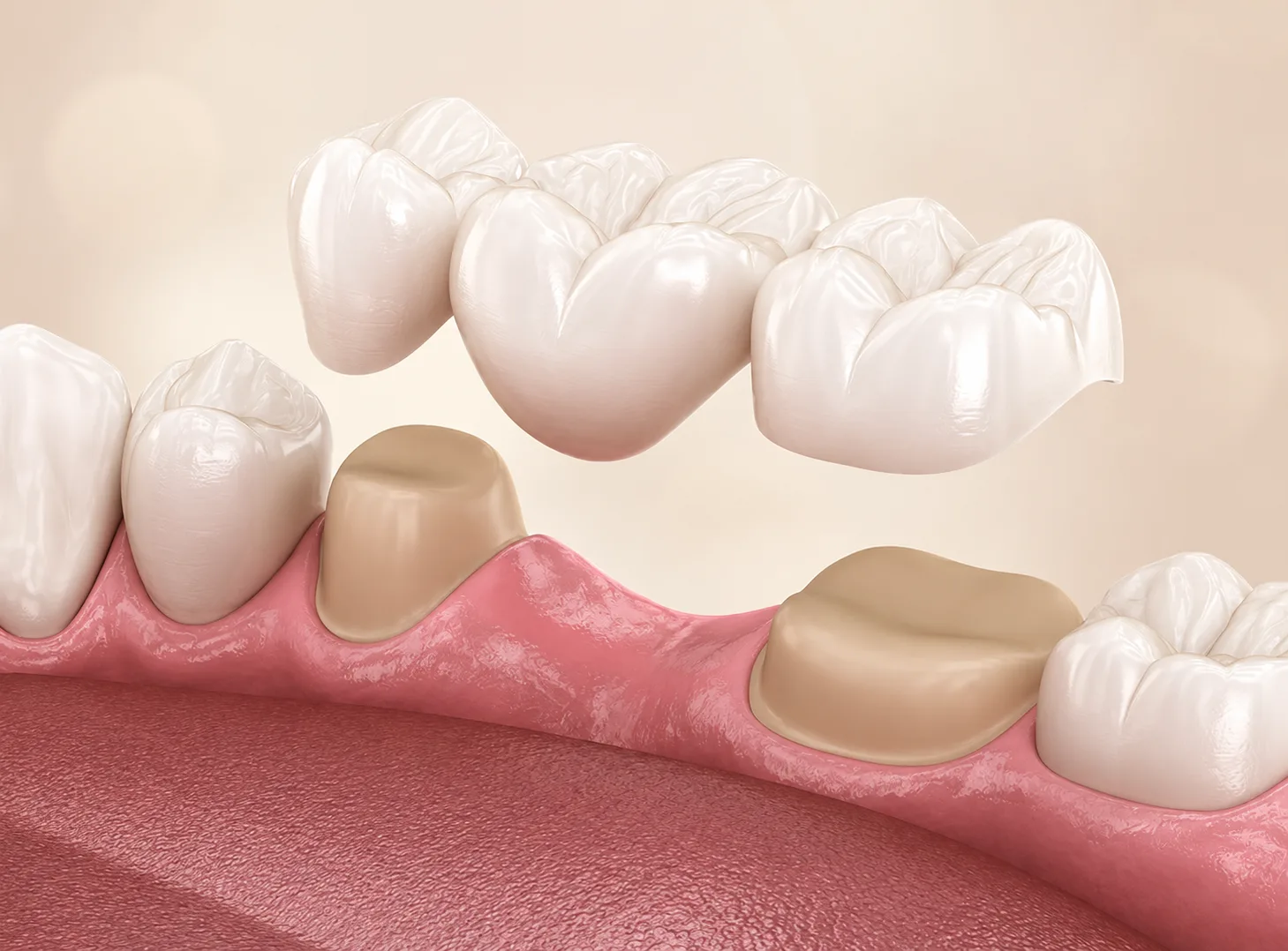 3D render of a porcelain dental bridge being placed over two prepared teeth