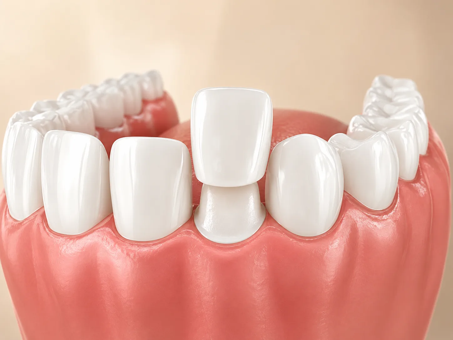 Porcelain veneer shell being bonded to tooth Plantation Florida