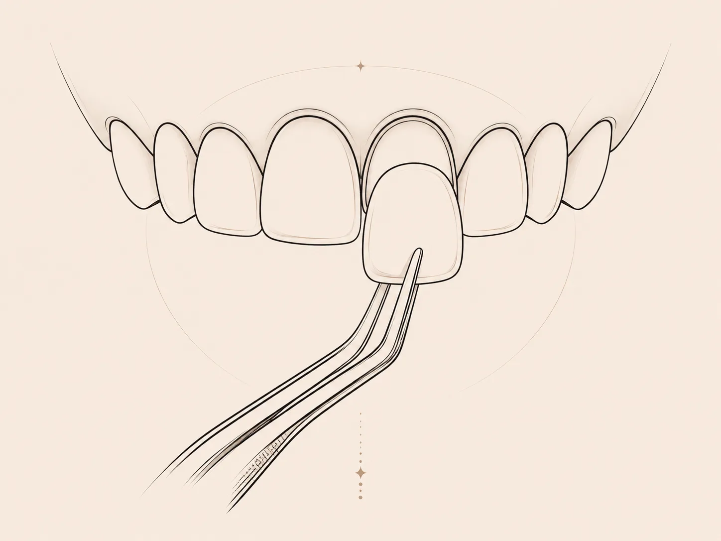Porcelain veneer line illustration Plantation Florida
