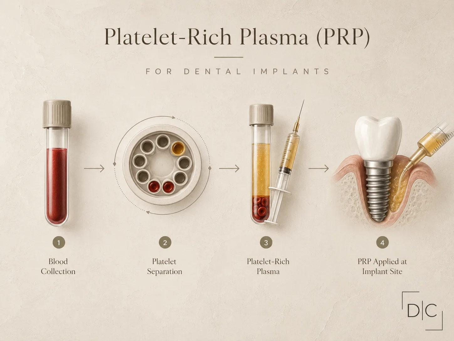 PRP process diagram for dental implants showing blood collection, platelet separation, platelet rich plasma preparation, and application at implant site