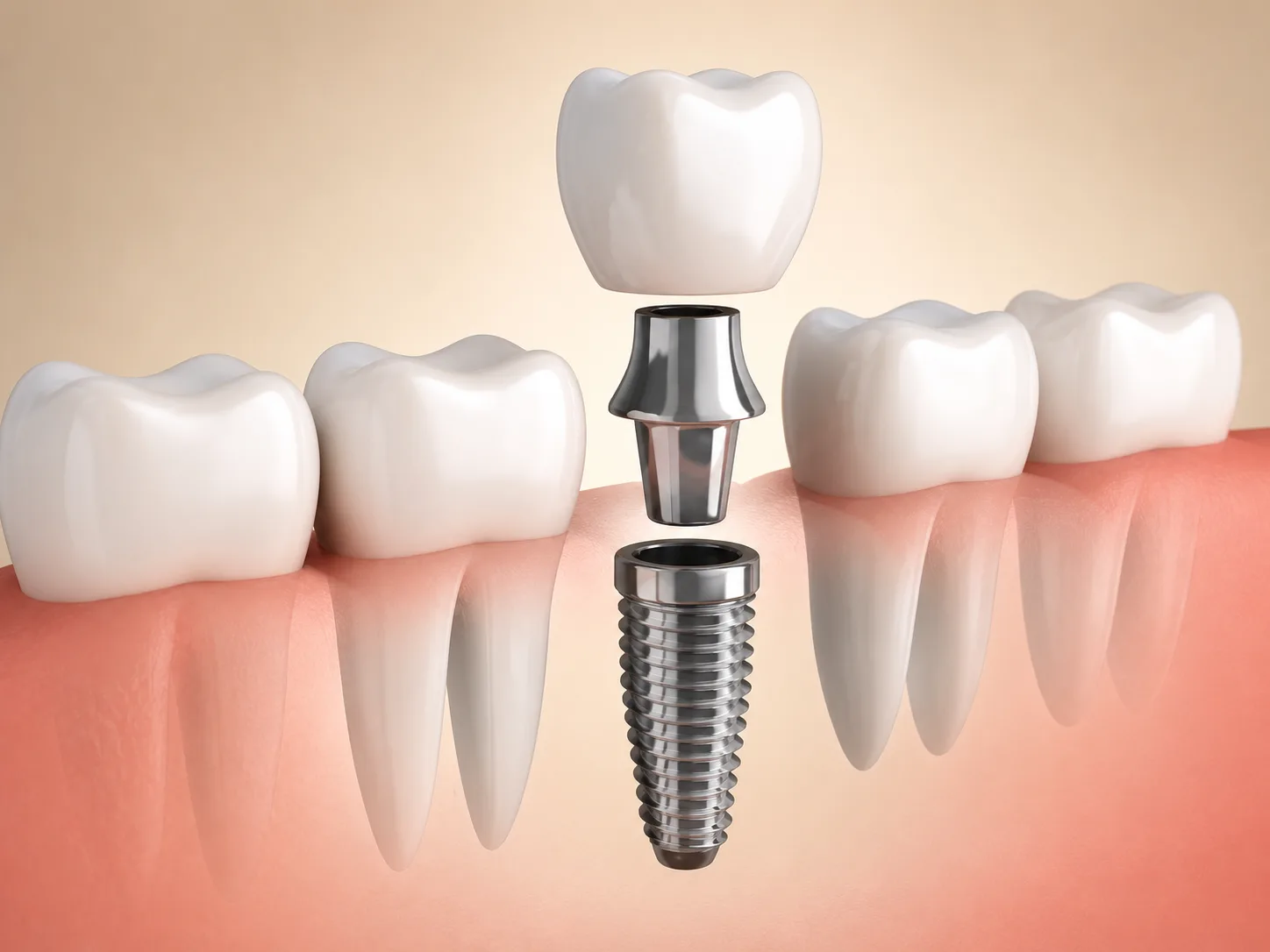 Diagram showing a dental implant post, abutment, and crown in the jawbone