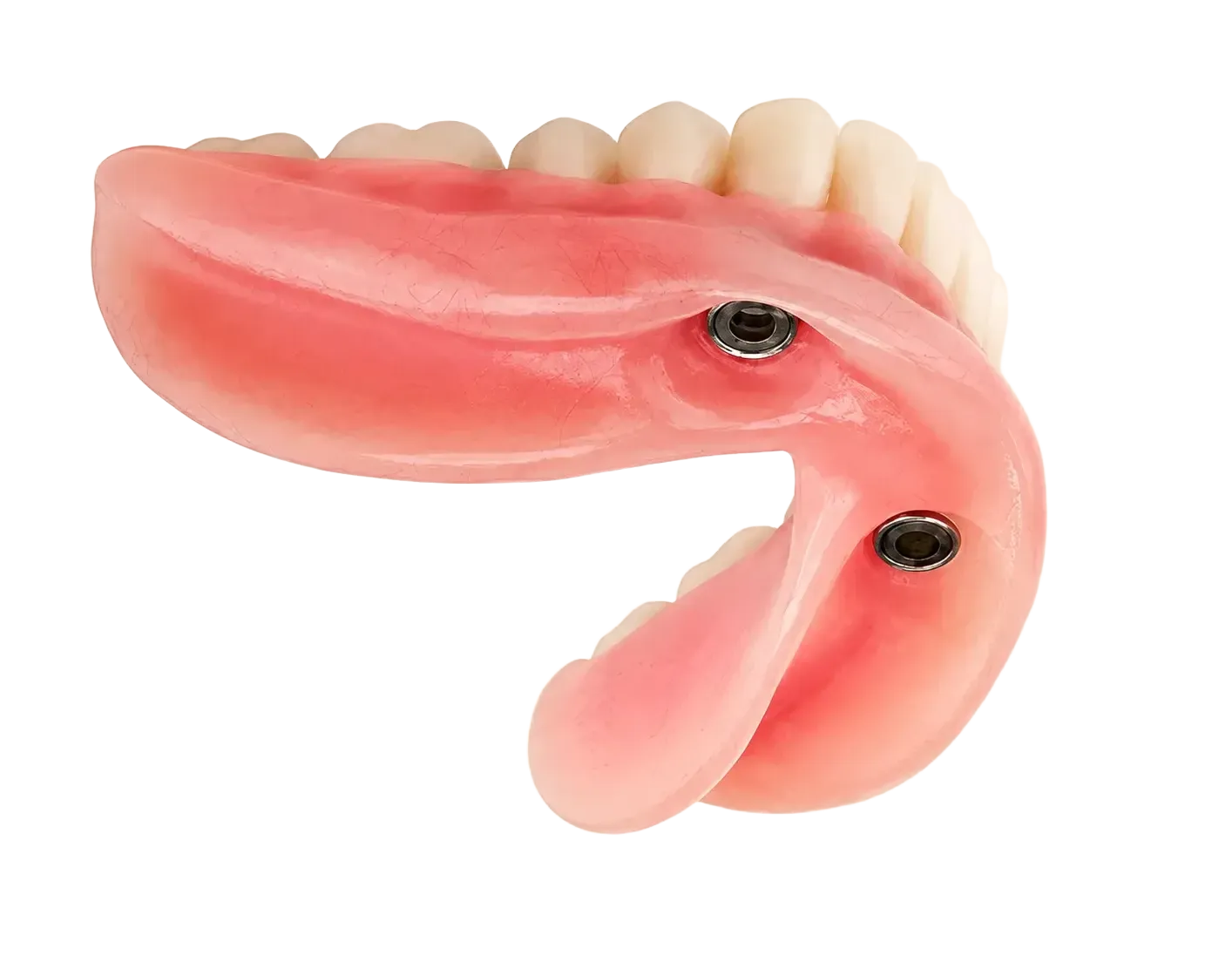 Close-up of a snap-on implant-retained overdenture showing the attachment mechanism