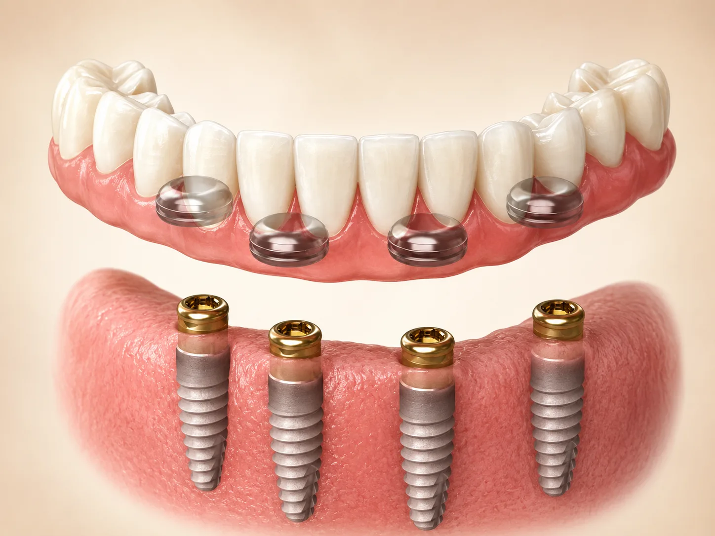 Diagram showing four dental implants being fitted with an overdenture prosthesis