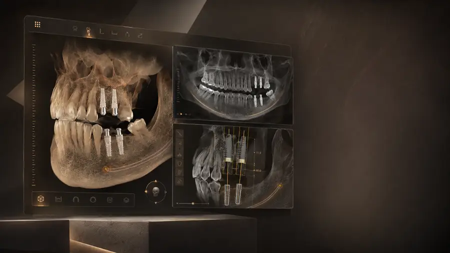 3D CBCT dental implant planning scan